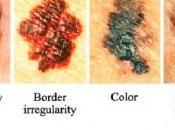 Cancro della pelle cause prevenzione naturale