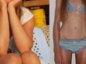 moda cede l’anoressia avanza: donne sempre piu’ magre
