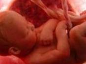 Parto pretermine possibili cause