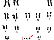 anomalie cromosomi mutazioni genetiche