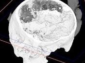 Cervello conservato vecchio oltre 2.500 anni