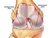 Combattere l’artrite reumatoide dieta esercizio fisico