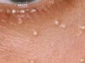 Cura della pelle: grani milio (punti bianchi) cosa sono come eliminarli
