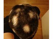 Come curare l’Alopecia androgenetica