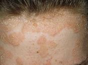 Psoriasi