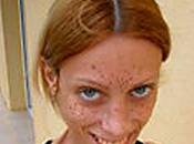 Parigi: morta anoressia isabelle caro, modella protagonista dello spot oliviero toscani