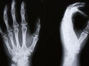 Artrosi alle mani, prevenzione fondamentale