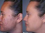 Cicatrici acne, curarle possibile