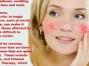 Emanuela dieta Dott.Mozzi: Rosacea, emicrania prolasso mitralico