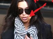 Kardashian nuove labbra collogene!