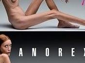 L'anoressia storia vera