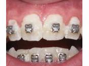 L’importanza dell’igiene orale durante trattamento ortodontico