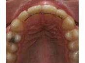 L’importanza della “contenzione” dopo trattamento ortodontico