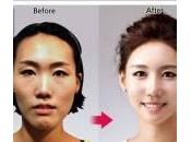 Chirurgia estetica sudcoreane: foto trasformazioni incredibili