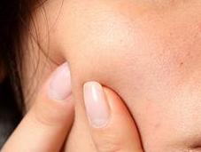 acne vulgaris dieta