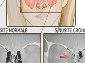 Ecco come curare sinusite rimedi efficaci