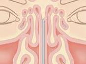 MILANO. rinite nelle diverse forme, principale responsabile “nasochiuso” terzo degli italiani, inclusi bambini.