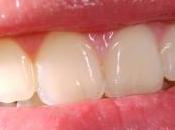 Gengiviti ulcerazioni orali come curarle essenziali