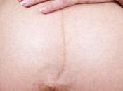 Smagliature gravidanza: come prevenirle