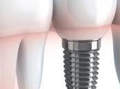 Vantaggi dell’Implantologia Dentale: Ritrovare Sorriso Qualità della Vita