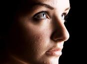 pillola utilizzare evitare l’acne?