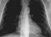 Polmoniti: quasi contratto ospedale