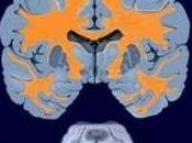 Metodo Zamboni Sclerosi Multipla: dubbi sullo studio Cosmo dell’Aism