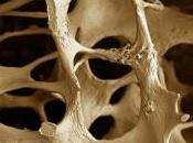 Test line osteoporosi, rischi donna anni