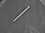 Illinois: trentaduenne aveva chiodo cervello!