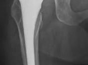 Protesi all'anca rischio cobalto