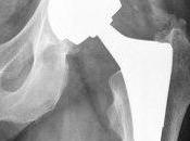 Protesi all'anca difettose: partono controlli nelle Marche