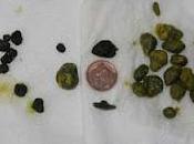 metodo naturale domestico depurare fegato espellere calcoli alla cistifellea senza dolore